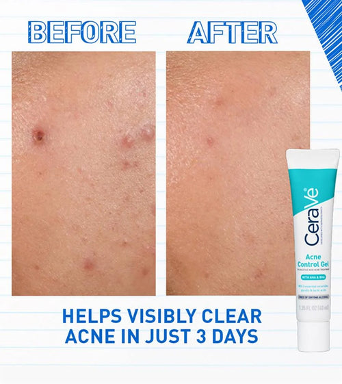 CERAVE ACNE CONTROL GEL (Tratamiento acne)