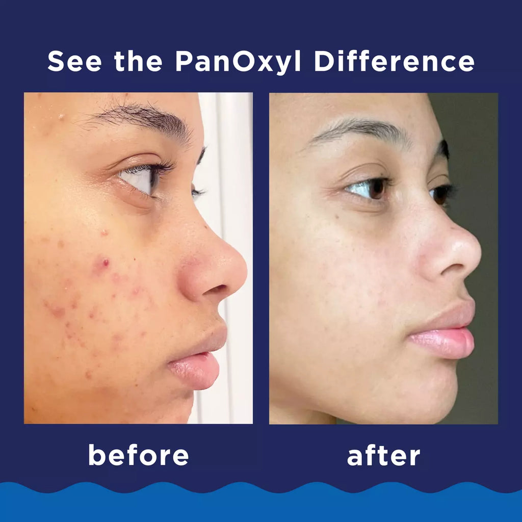 Limpiador Anti Acne PanOxyl